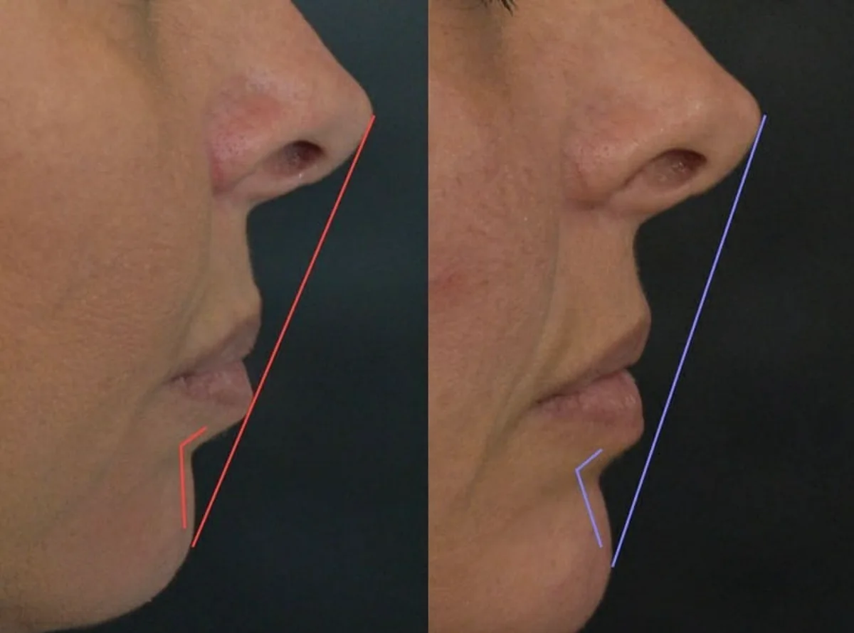Side profile before and after dermal filler treatment to the chin