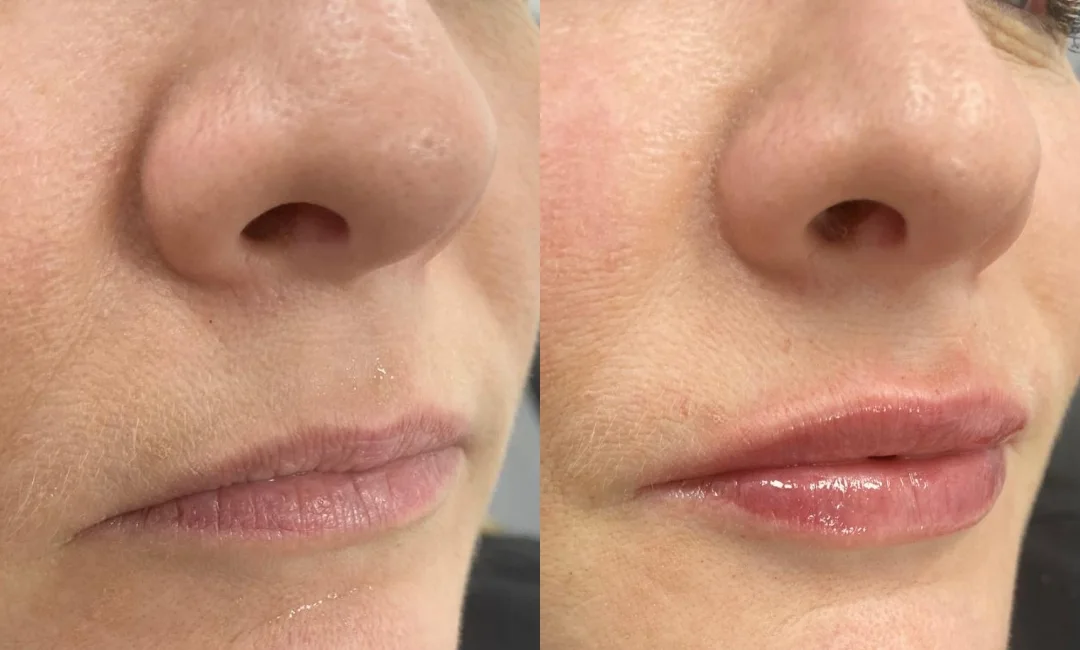 Before and after dermal filler treatment to the lips