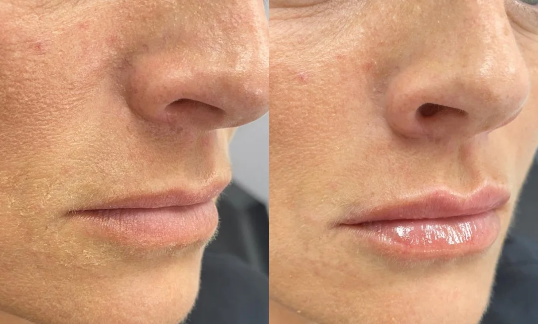 Three-quarter view before and after dermal filler treatment to the lips