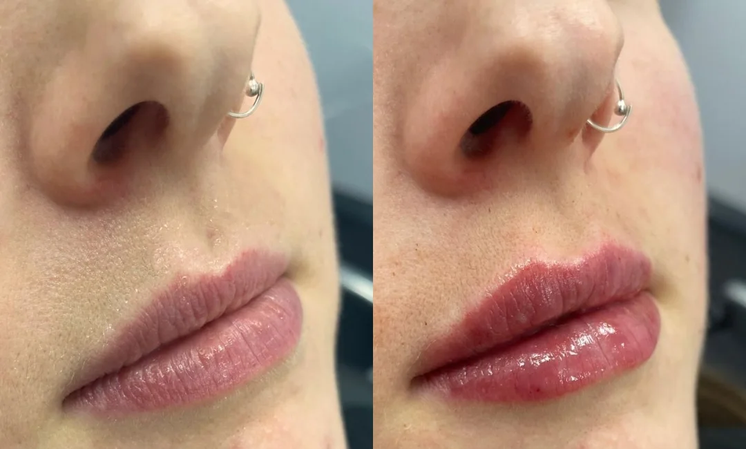 Angled view before and after dermal filler treatment to the lips
